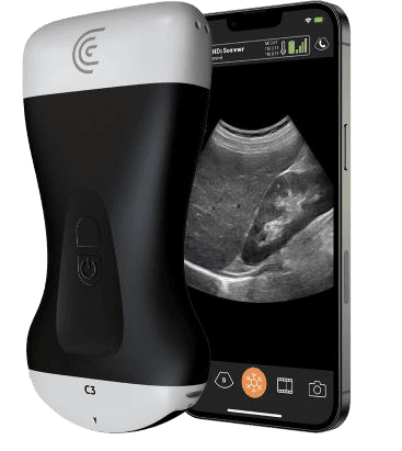 Échographe portable sans fil Clarius C3 HD3 : sonde sans fil devant un smartphone affichant une image d’échographie abdominale