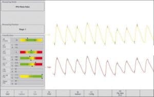 Capture du logiciel VenoScreen montrant une analyse artérielle PPG disponible en option